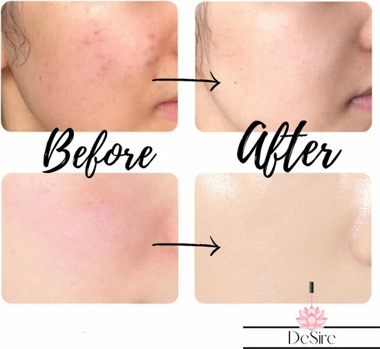 Desire Derma Roller - 540 Needle - 0.5 MM Naald - Steriel Verpakt - Skin Roller - Huid Verzorging - Huidverzorging - Dermaroller - Baardgroei Stimuleren - HaarGroei Stimulatie - Haar En Huid - Strakke Huid - Acné - Puisten - Striae - Littekens 7 Desire Derma Roller - 540 Needle - 0.5 MM Naald - Steriel Verpakt - Skin Roller - Huid Verzorging - Huidverzorging - Dermaroller - Baardgroei Stimuleren - HaarGroei Stimulatie - Haar En Huid - Strakke Huid - Acné - Puisten - Striae - Littekens - Afbeelding 7